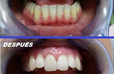 Estética Dental