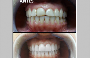 Estética Dental